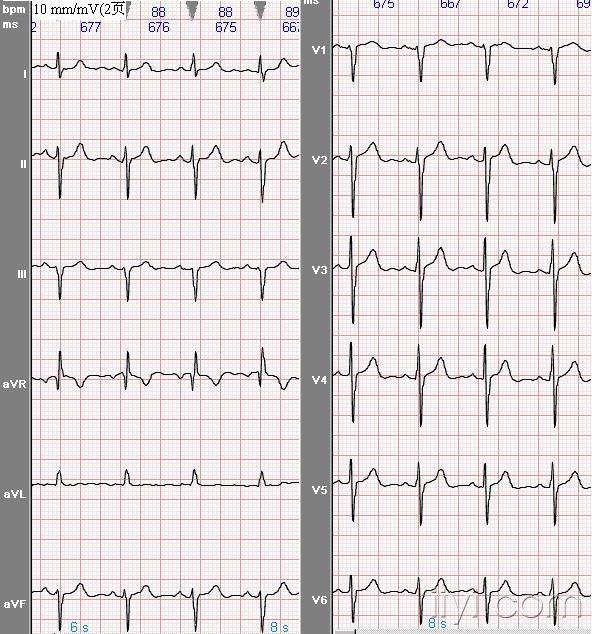 心电轴左偏图片