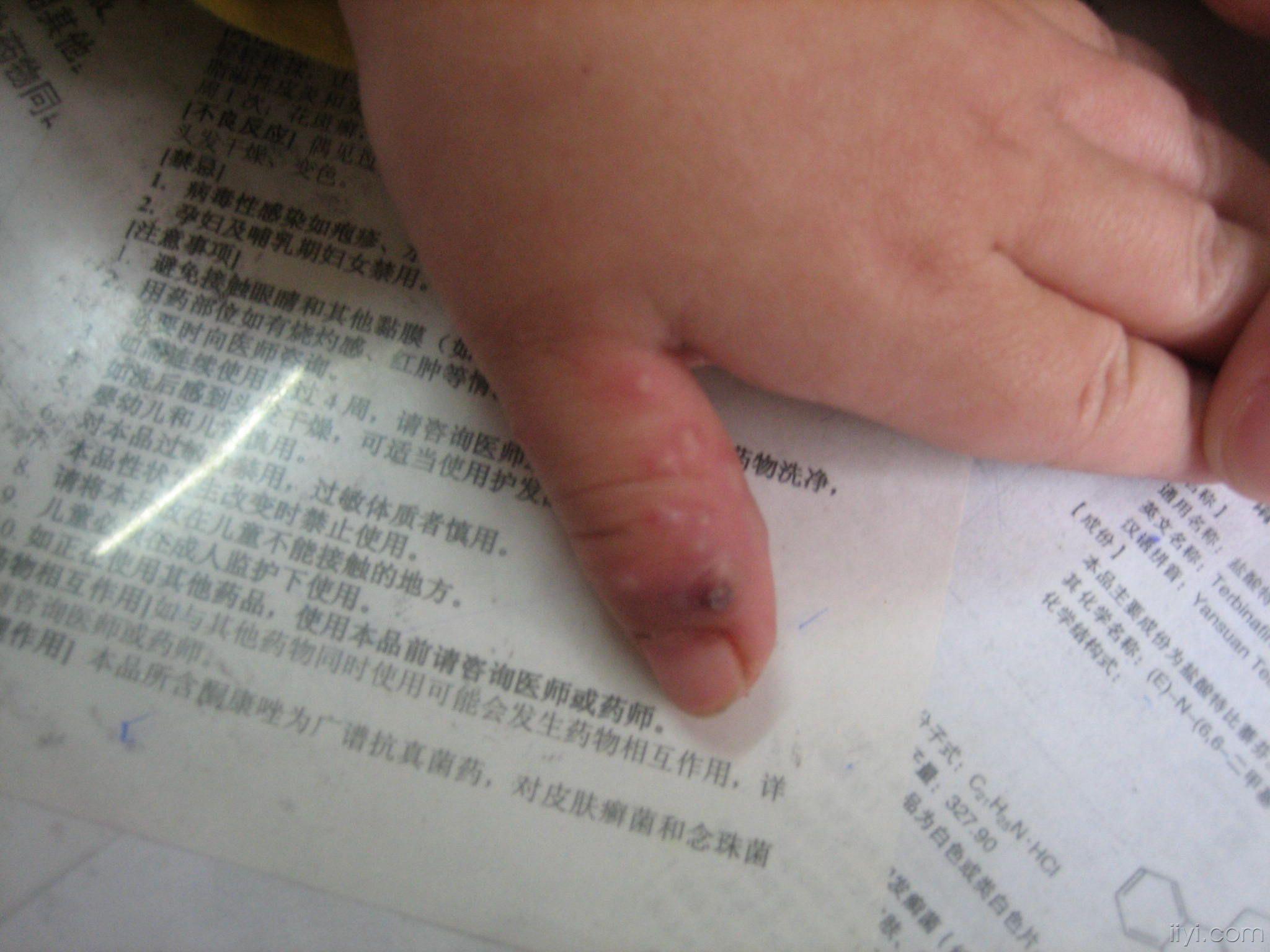 接种性单纯疱疹1例