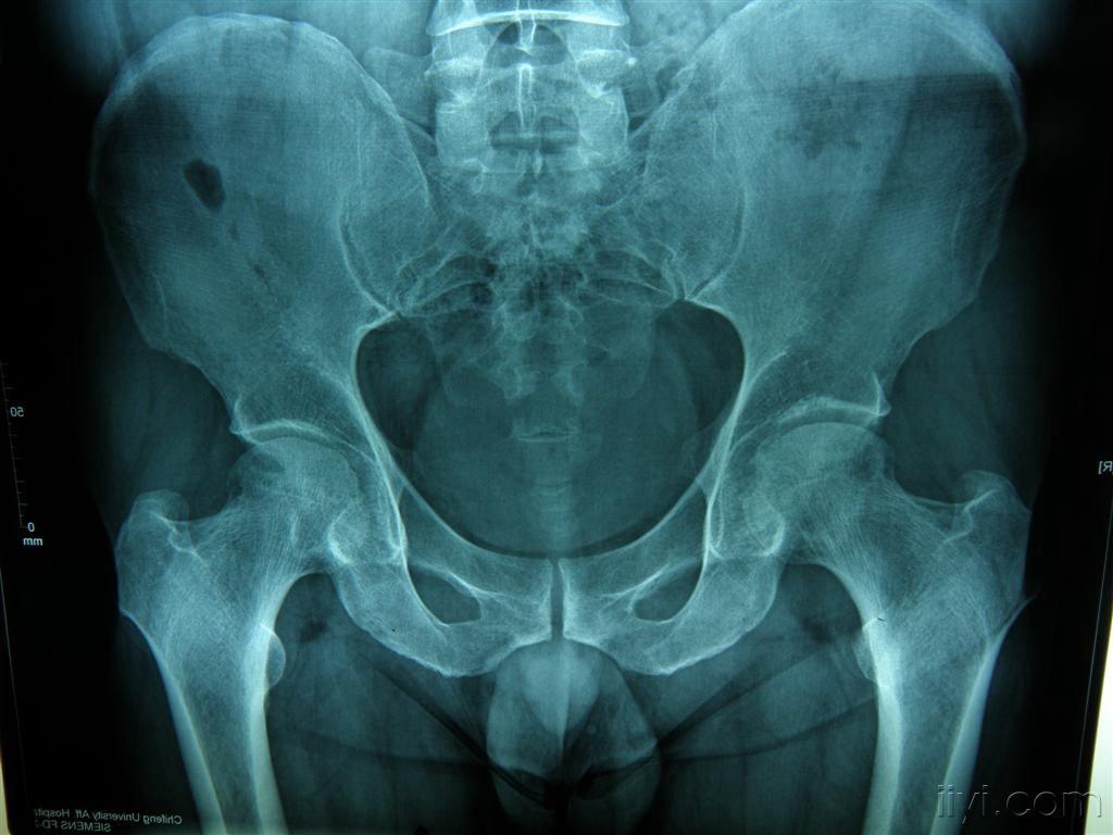 请教双侧股骨头缺血性坏死的最佳治疗方法