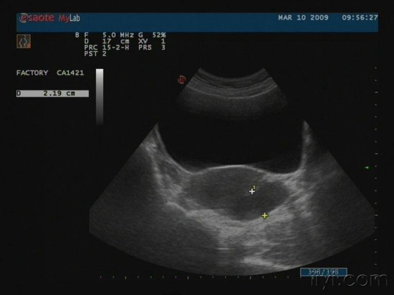 盆腔包块 超声医学讨论版 爱爱医医学论坛