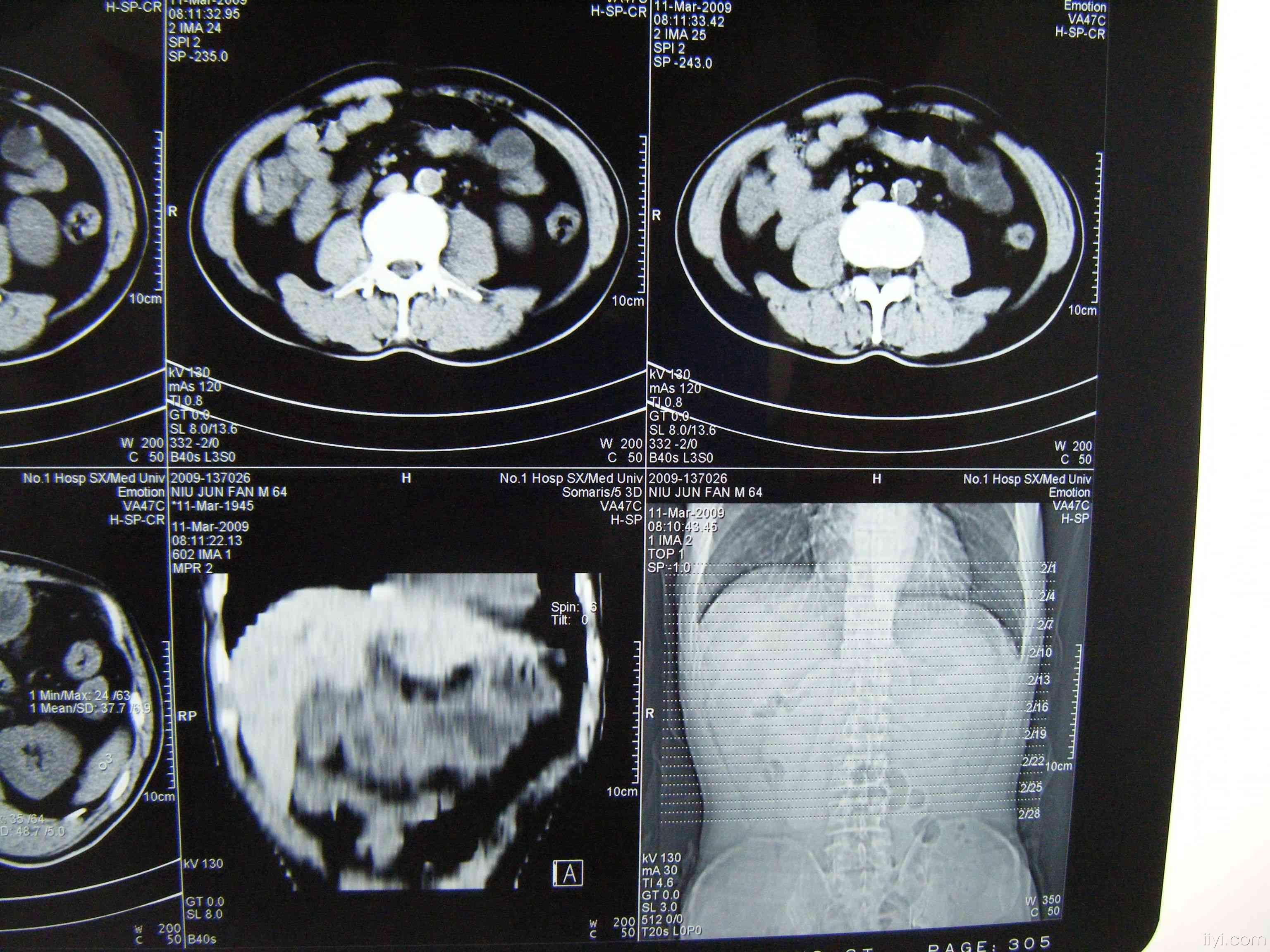胃癌ct图片 片子图片