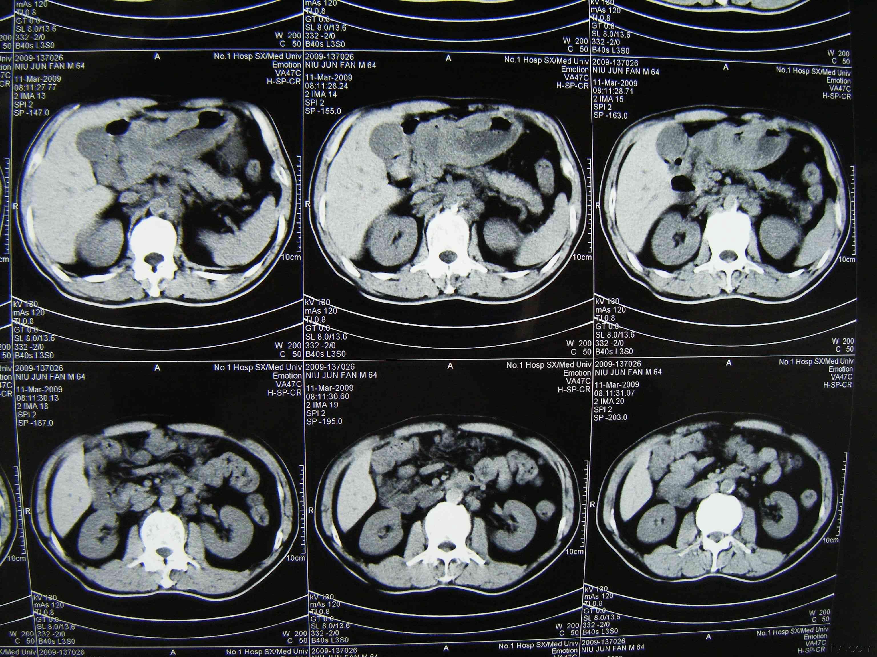 早期胃癌的片子图片