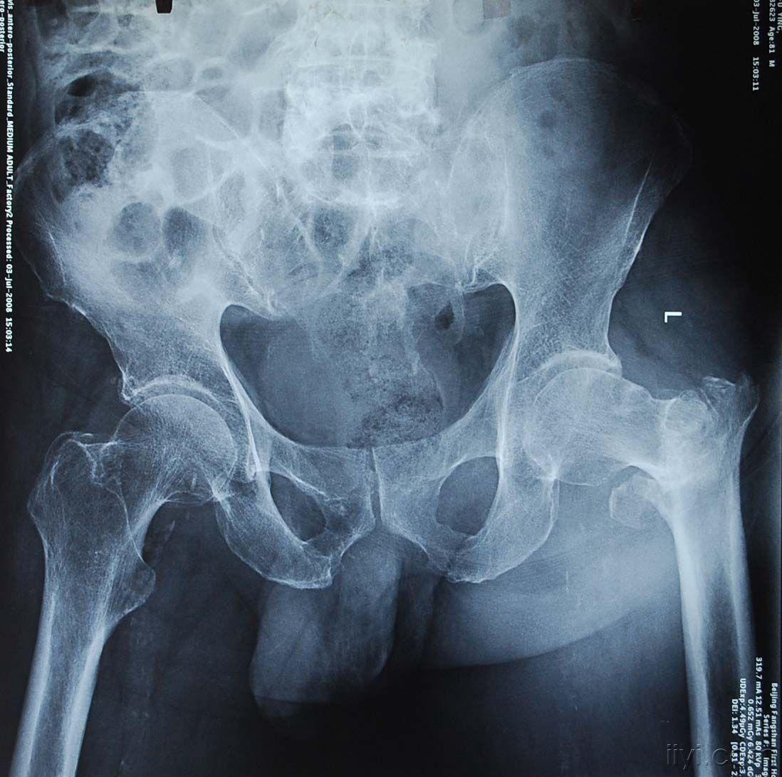 股骨粗隆间骨折pfna