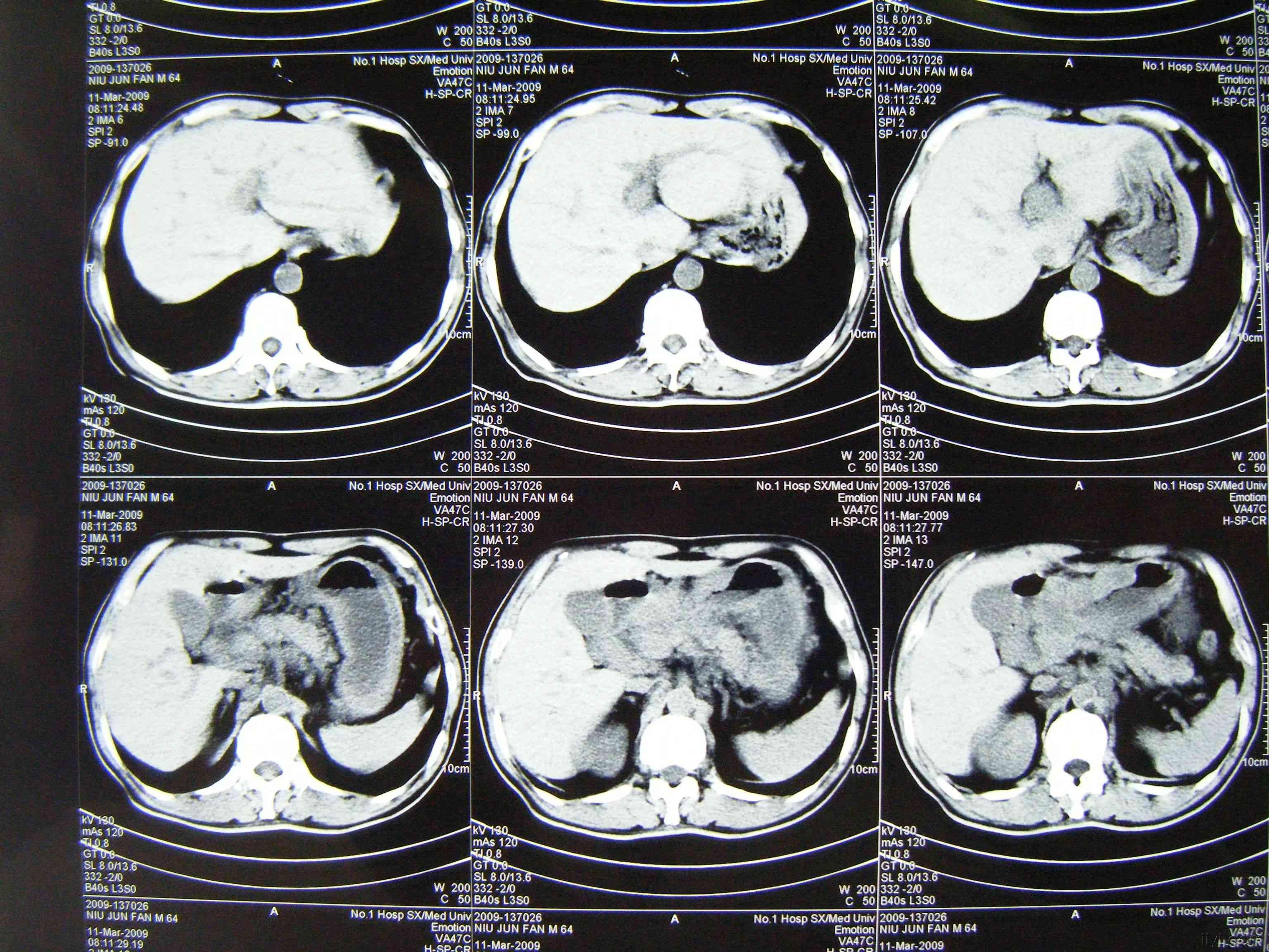 胃癌ct图片 片子图片