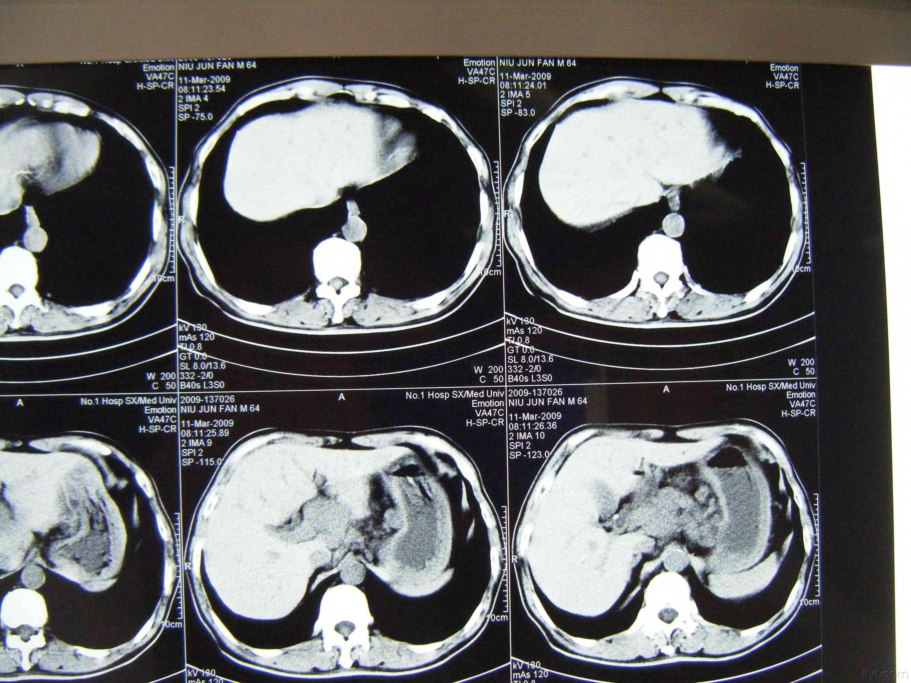 胃癌晚期扩散图片图片
