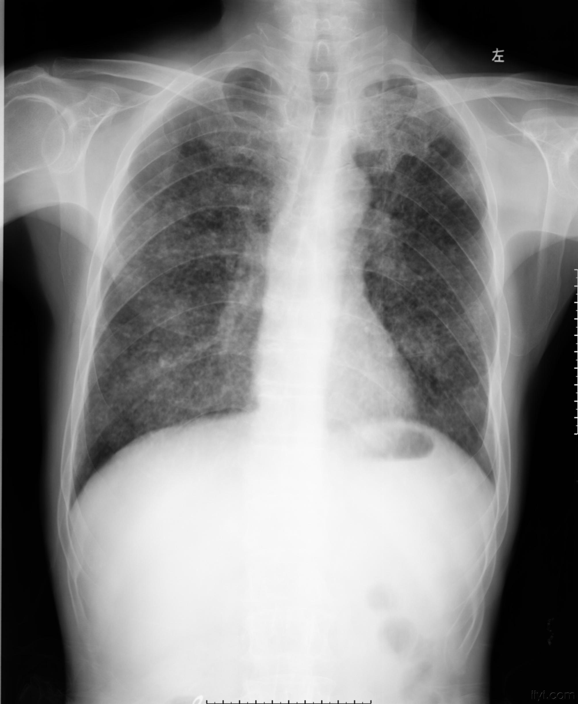 肺结核无症状说明什么 继发性肺结核严重不