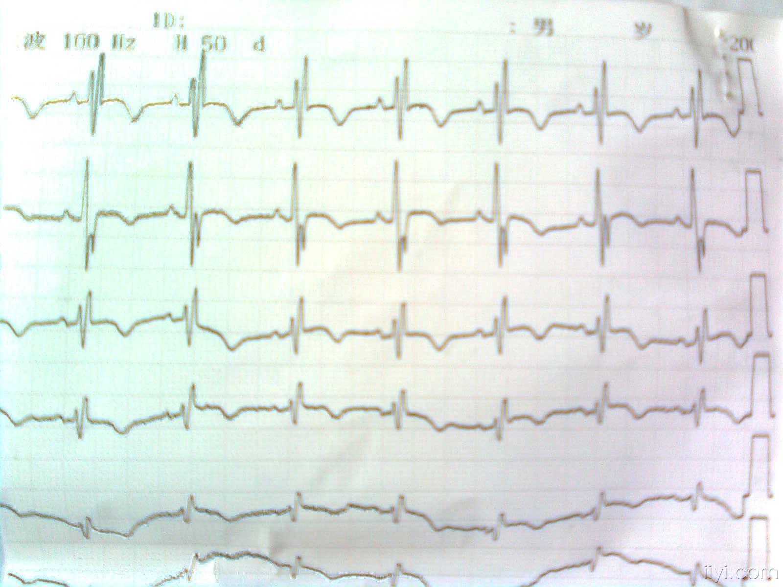 一份右束支合并前壁和下壁心梗的心电图