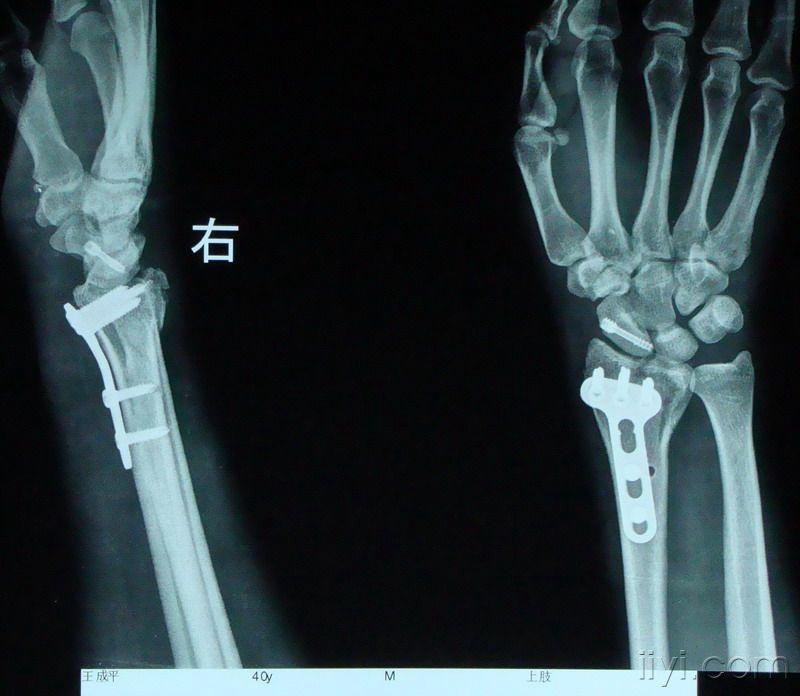 求助胫骨近端骨软骨瘤