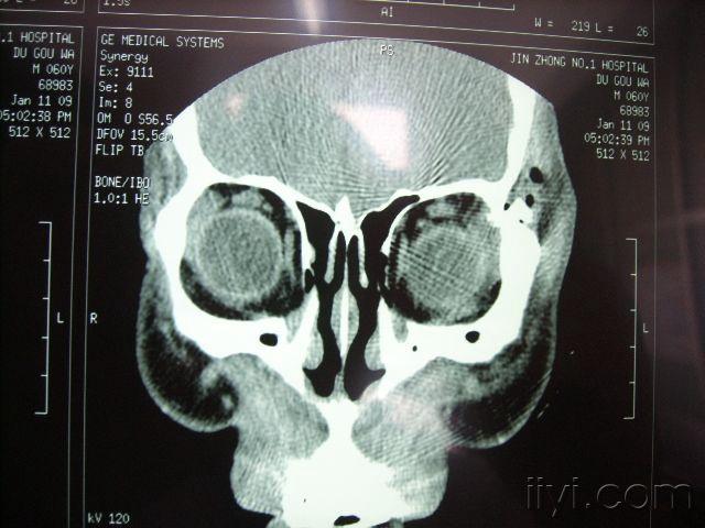 左眼眶内侧壁骨折图片图片