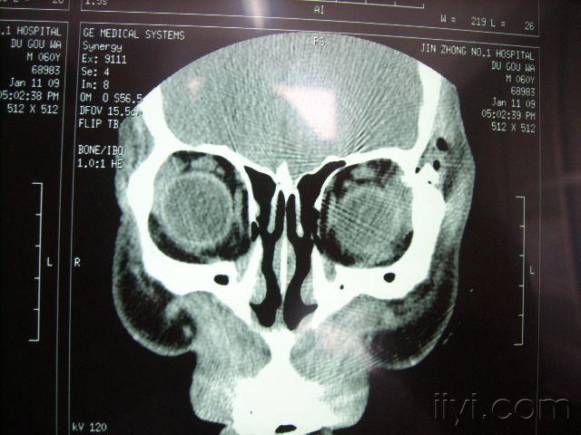 眼眶下壁骨折ct片图片图片