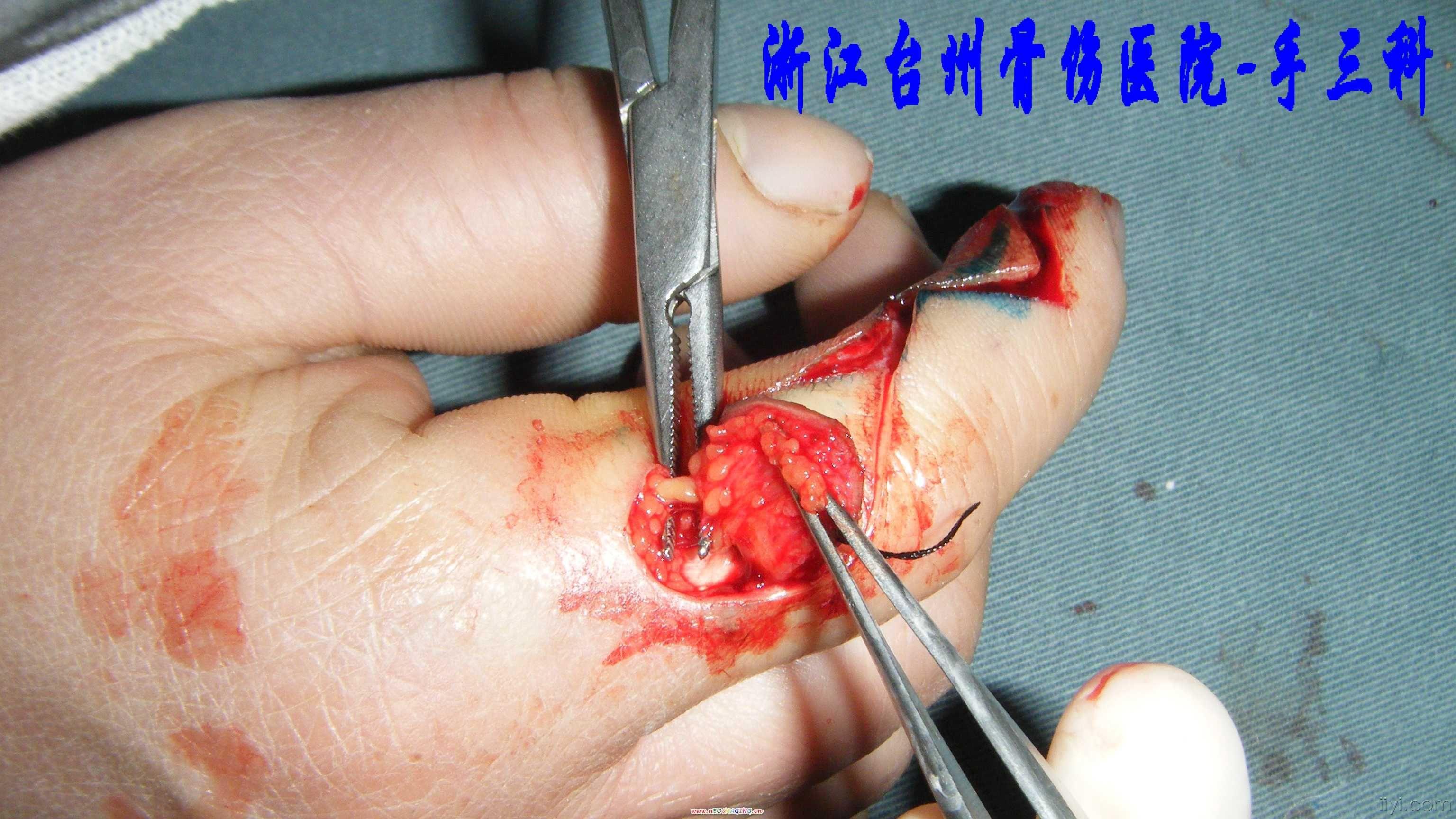 指背神经营养皮瓣1例