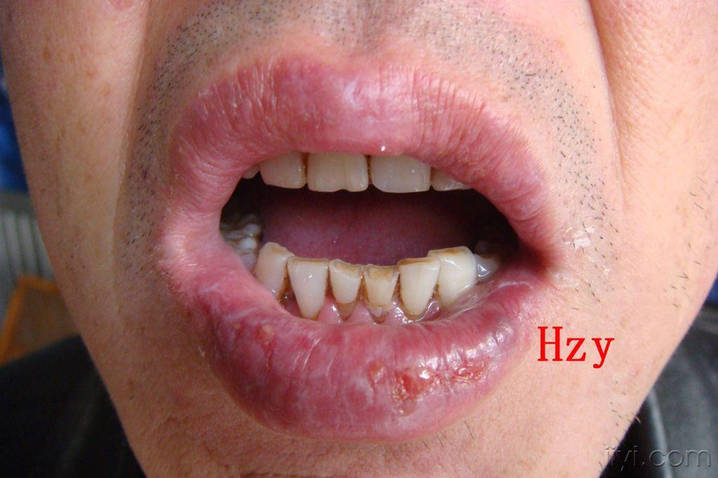 患者65岁下唇糜烂一个月左侧下唇唇红部暗紫红色皮损25年