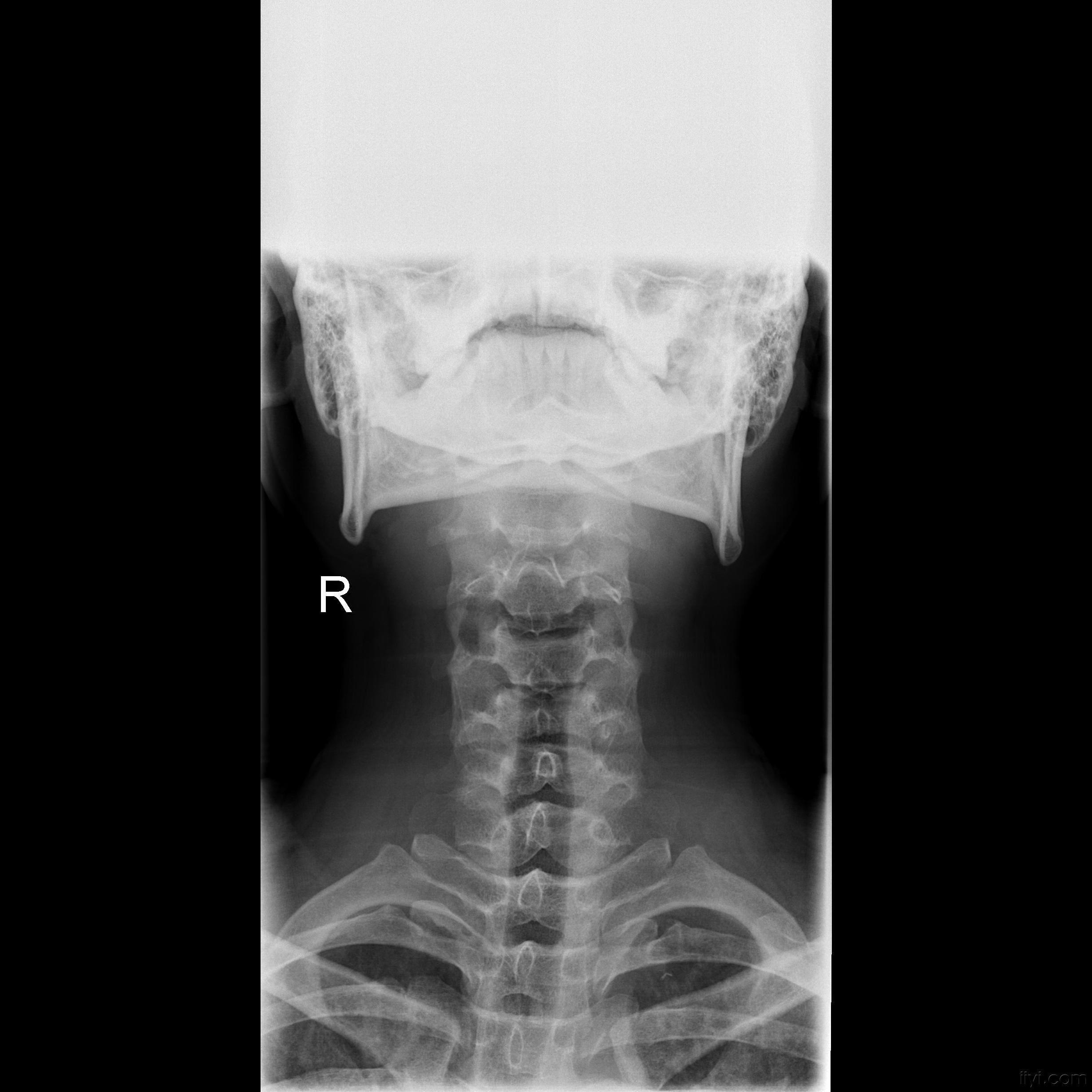 颈椎片子图片