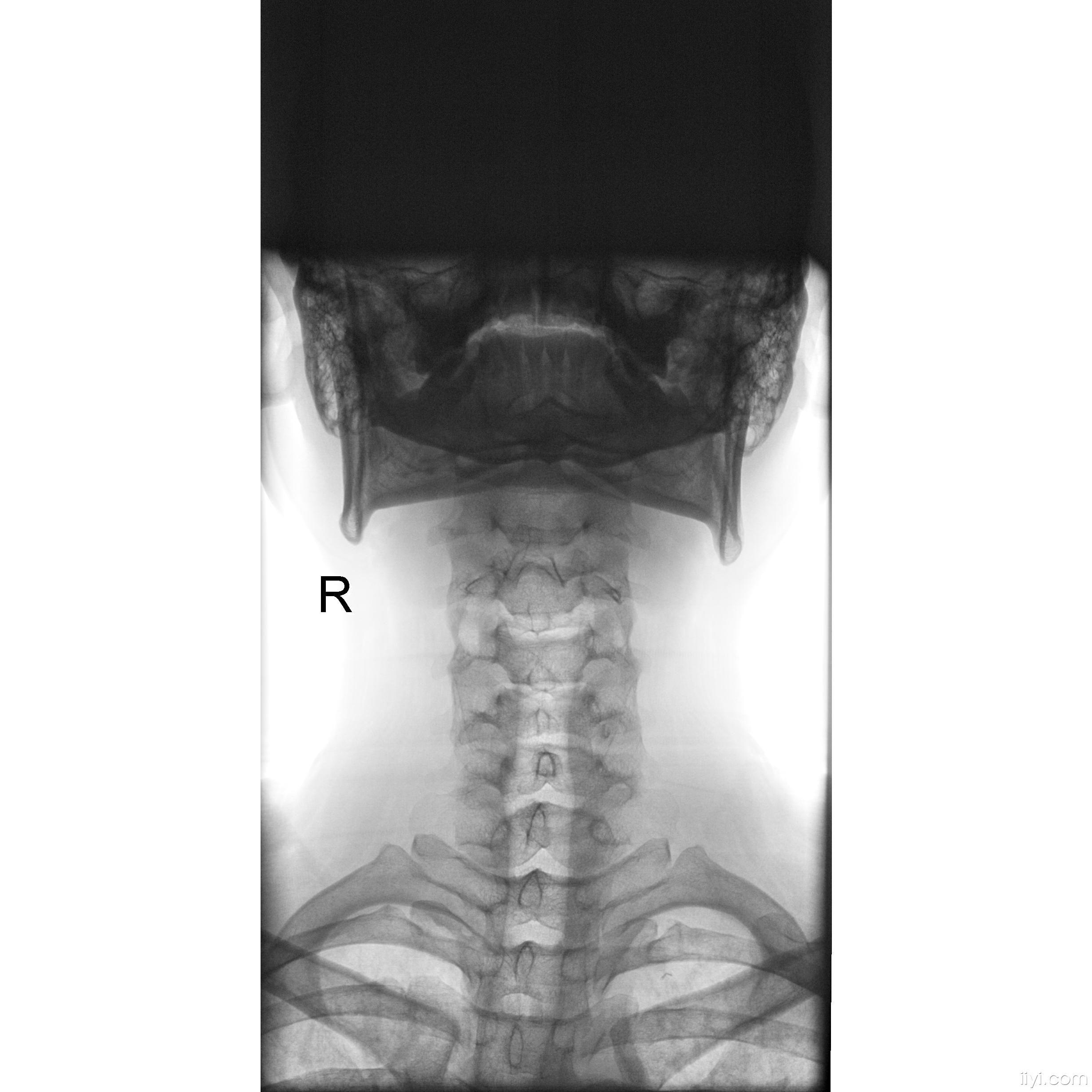 正常颈椎dr图片图片