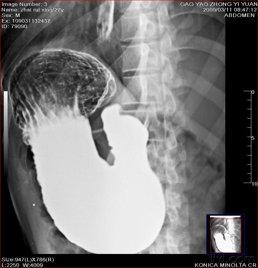 上消化道钡餐同一病人几个病典型征象有出现啦