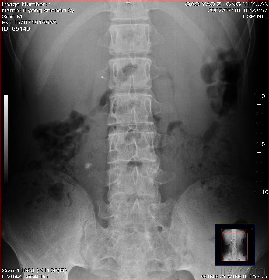 强直性脊柱炎x线图片图片