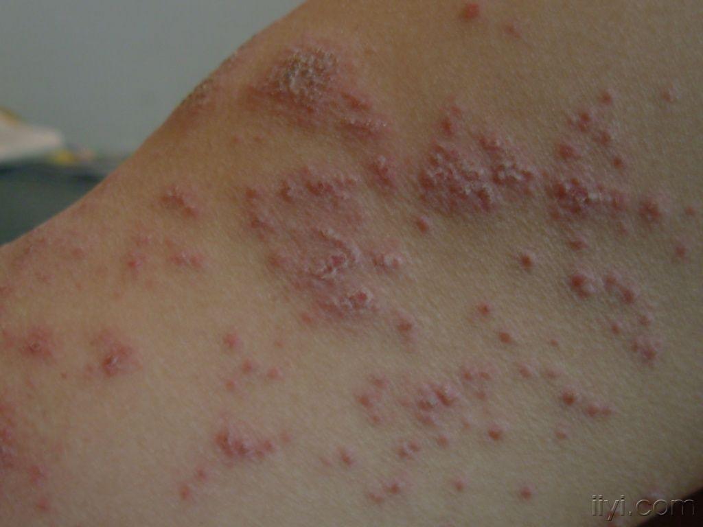 病毒性湿疹症状图片