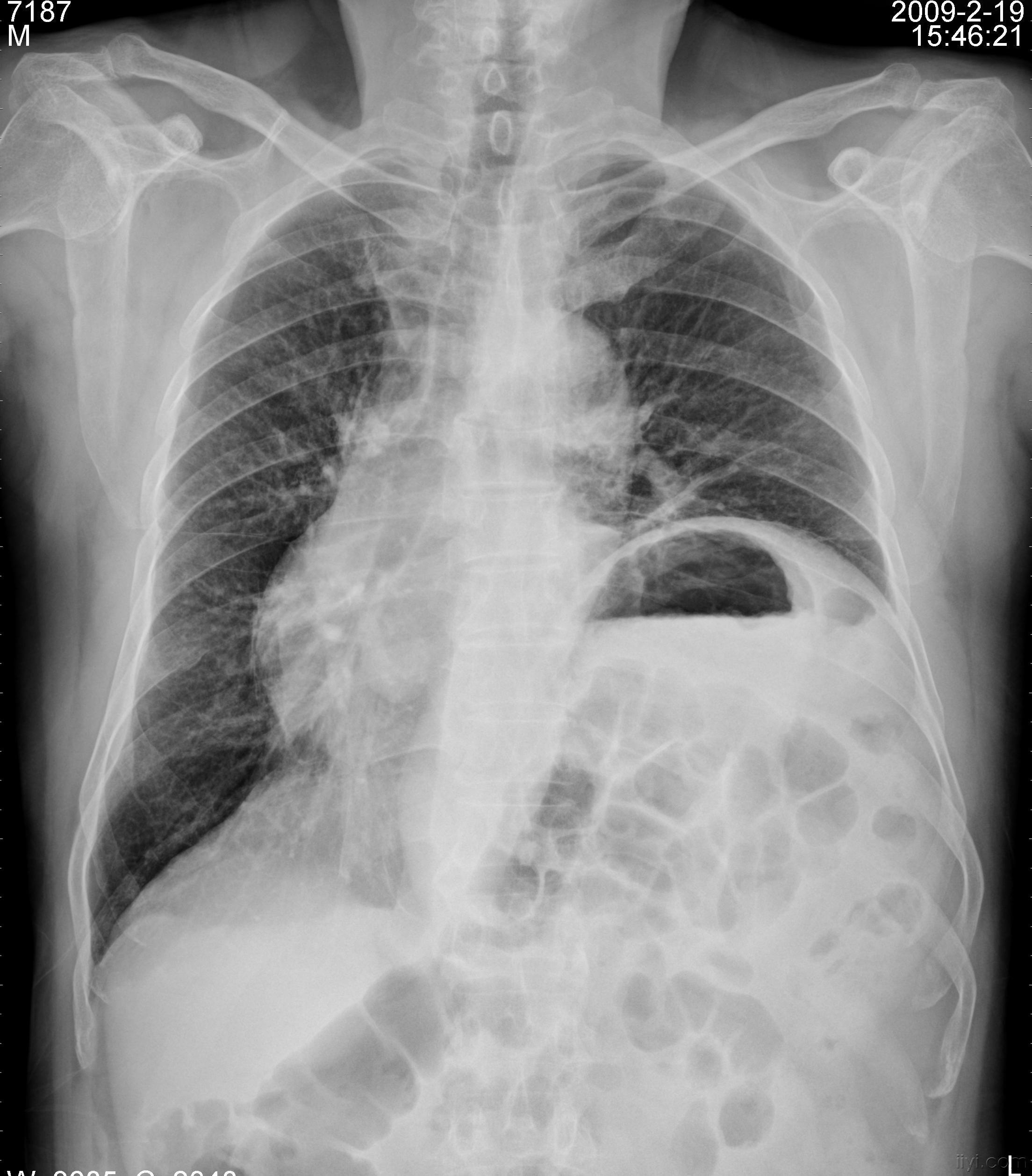 原创是右位心吗随访资料已经公布