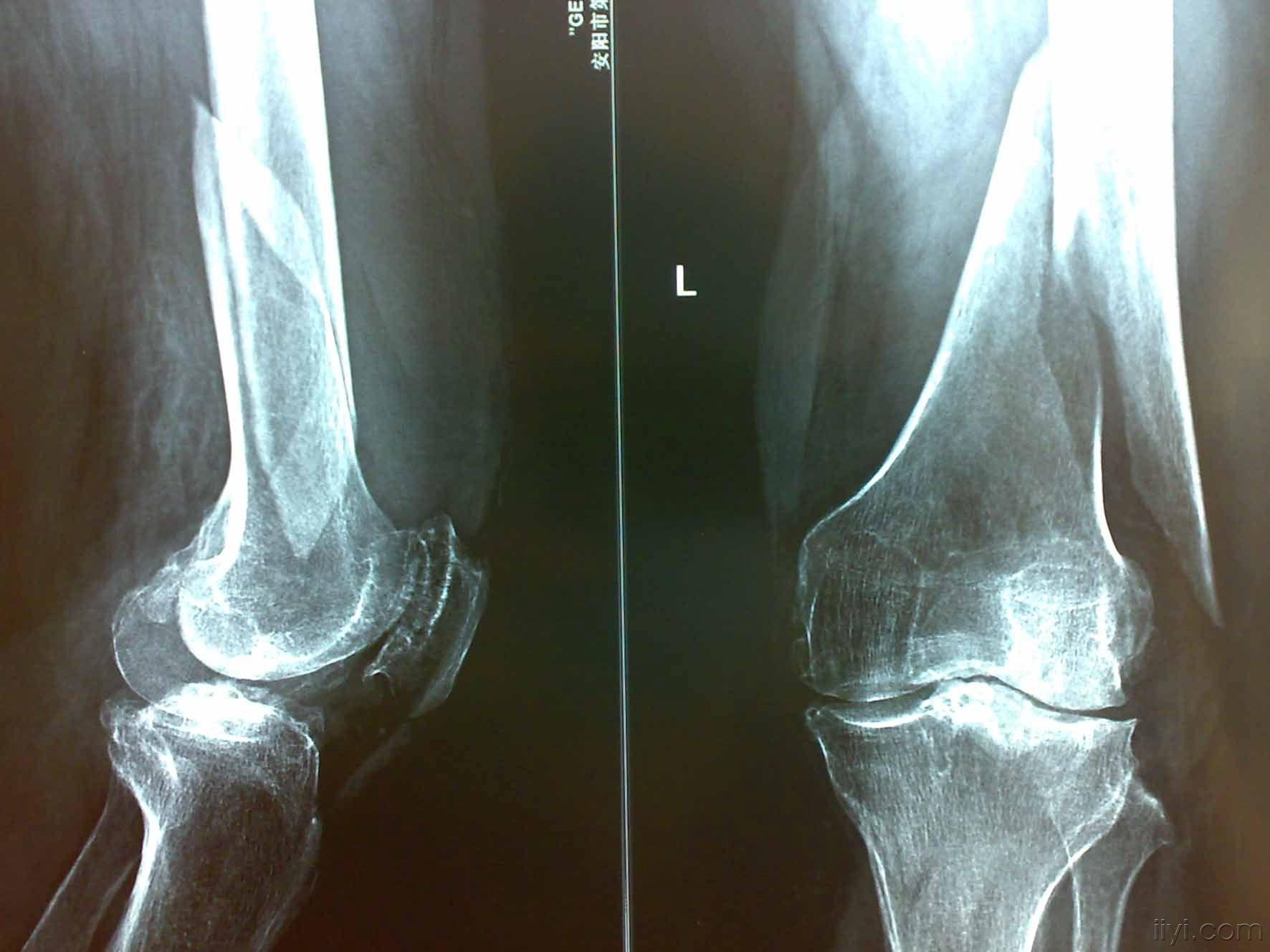 膝盖骨折片子真实图图片