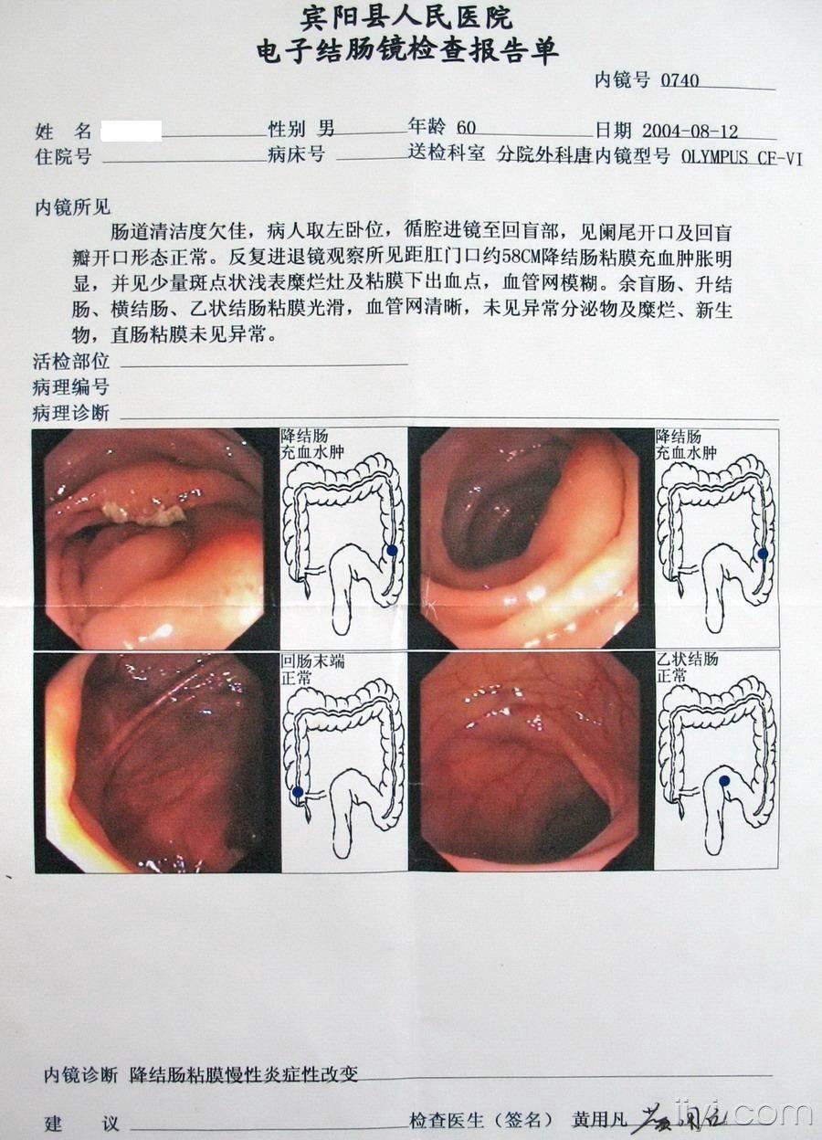 肝硬化 降結腸 腎結石 失代償期 胃鏡檢查