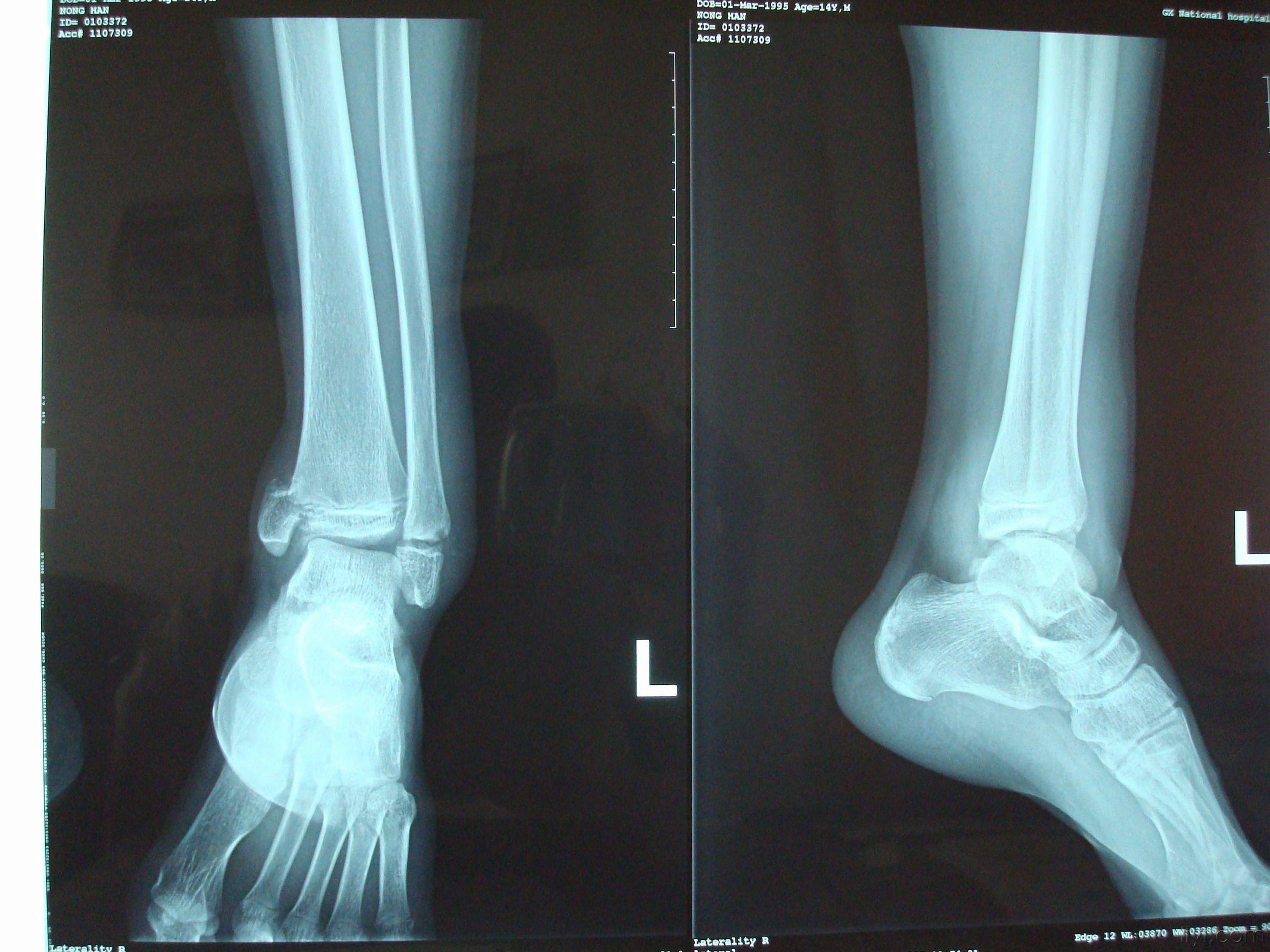 脚踝骨裂片子图片