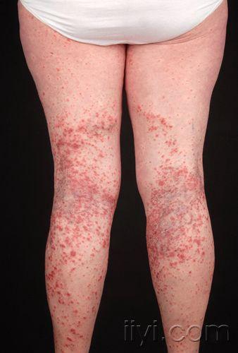 皮肤病猜猜看02——急性痘疮样苔藓状糠疹