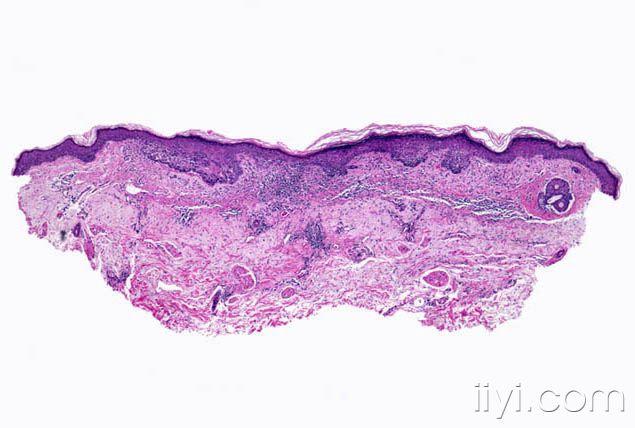 皮肤病猜猜看——浅表型基底细胞癌 - 皮肤及性传播疾病讨论版 - 爱爱