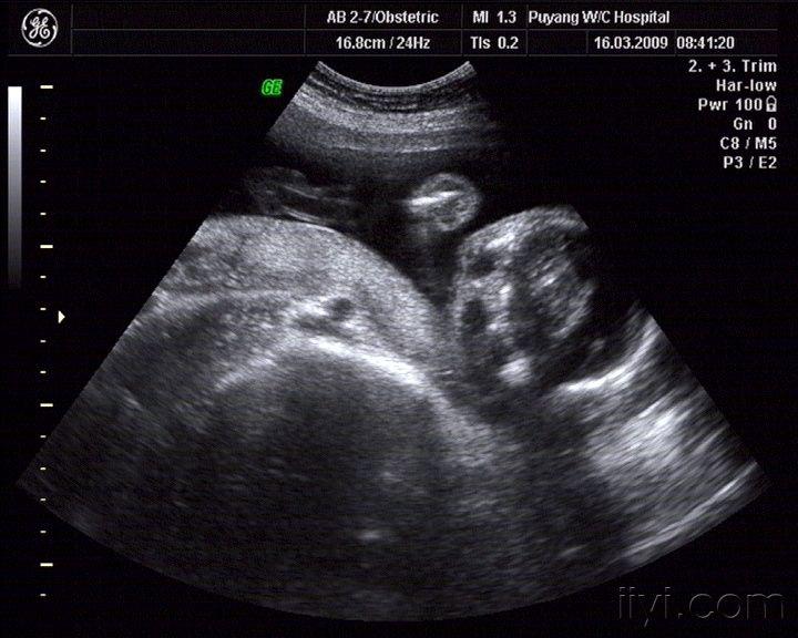 全前脑合并面部畸形三维图像