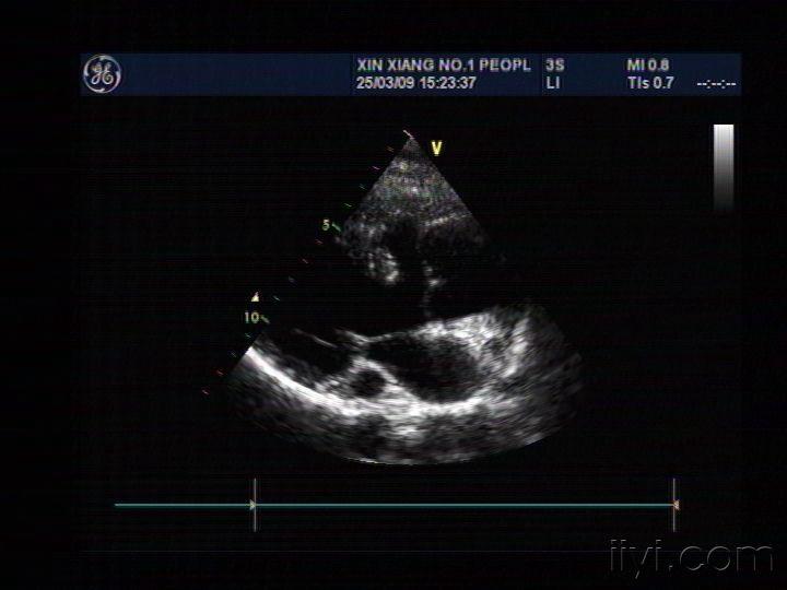 心脏冠状静脉窦超声图图片