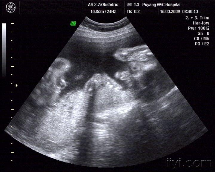 全前脑合并面部畸形,三维图像 - 超声医学讨论版 - 爱爱医医学论坛