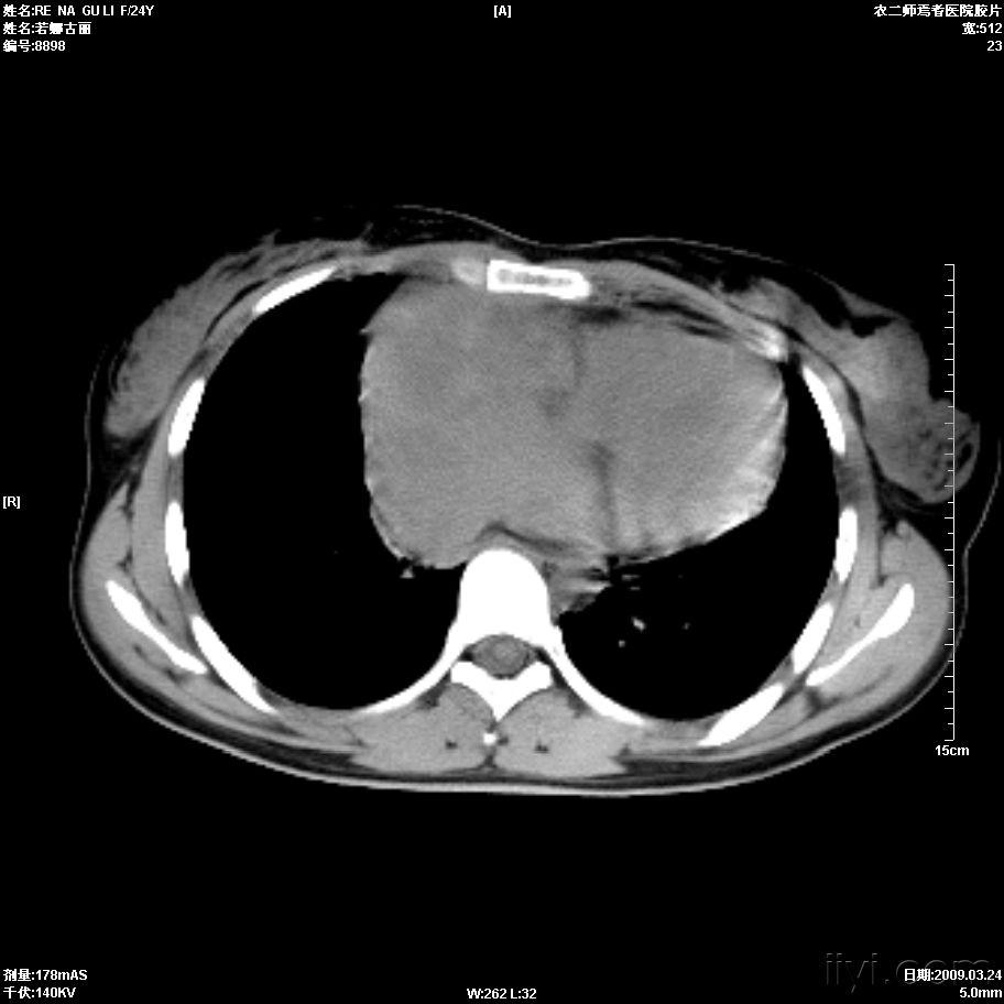 右心房壁肿块 - 医学影像学讨论版 - 爱爱医医学论坛