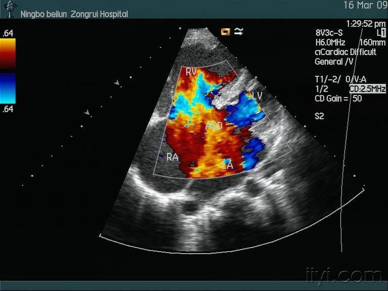 心内膜垫缺损部分型