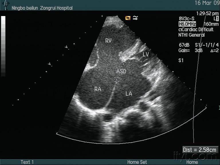 心内膜垫缺损超声图片