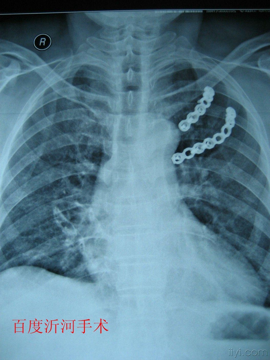 肋骨骨折手术固定图片 搜狗图片搜索