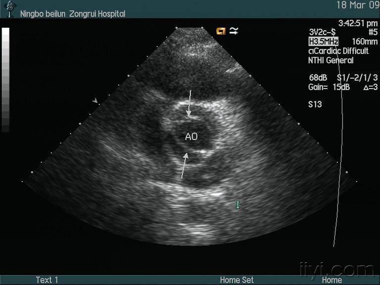 主动脉瓣二叶畸形 超声医学讨论版 爱爱医医学论坛