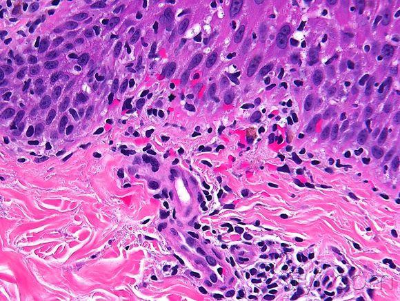 皮肤临床病理06线状苔藓