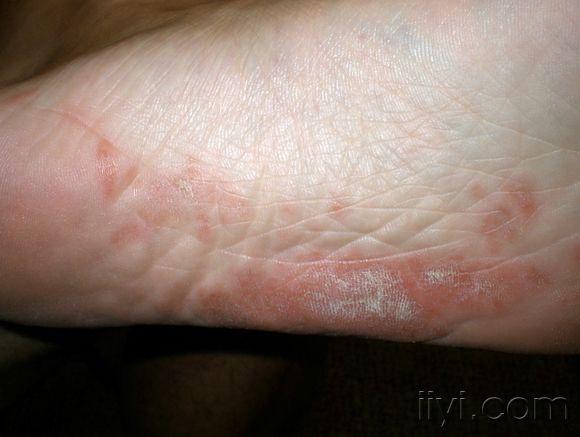 皮肤临床病理06线状苔藓