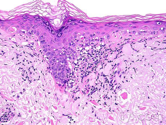 皮肤临床病理01红斑狼疮