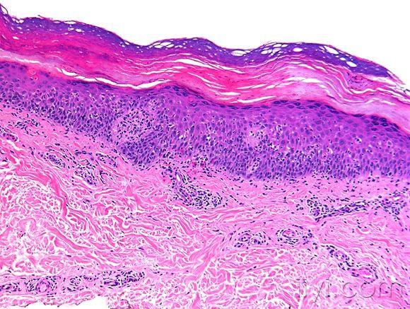皮肤临床病理06线状苔藓