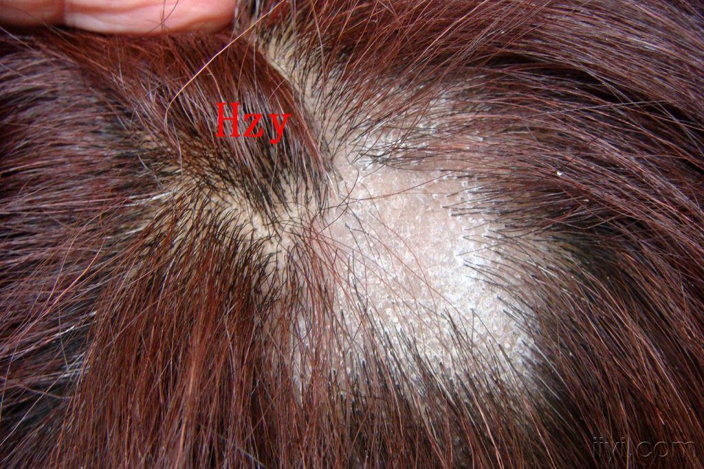 患者女性,45岁,头皮瘙痒,脱发数月
