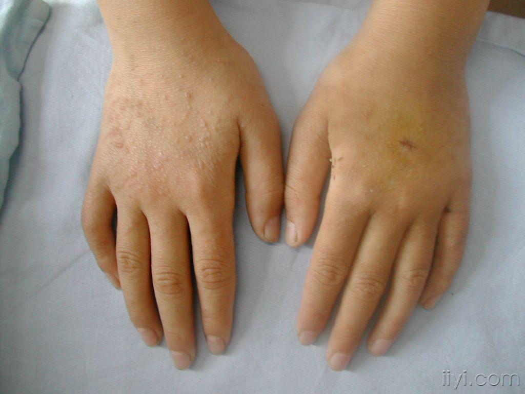 儿童皮肤角化症图片