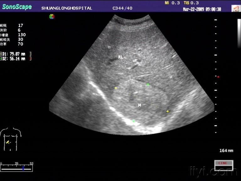 经典超声图片欣赏原发性肝ca