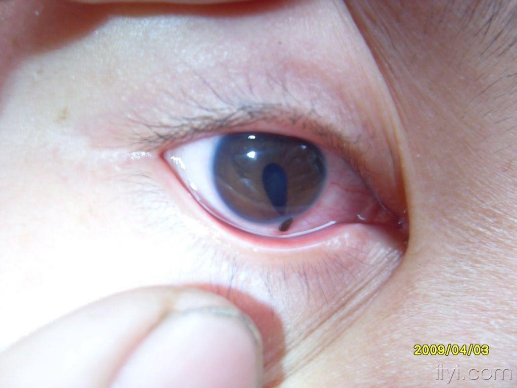 右眼刺伤有图片