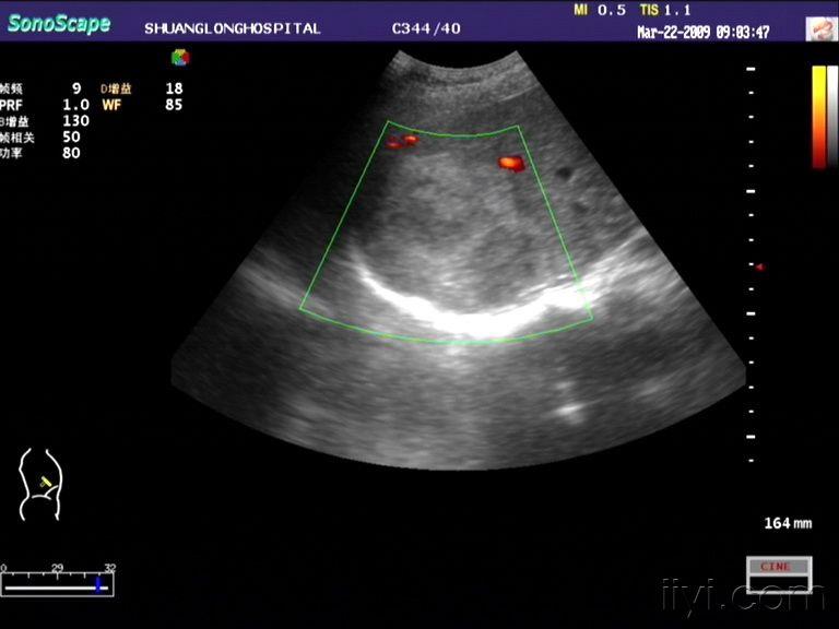 经典超声图片欣赏原发性肝ca
