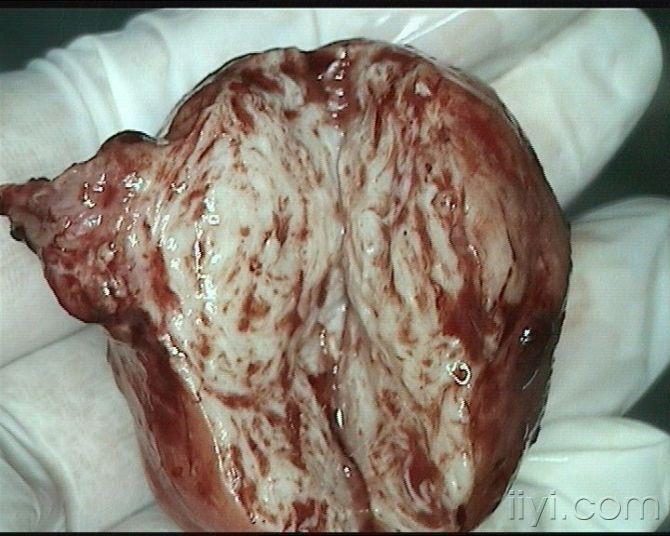 恶性宫颈赘生物图片图片