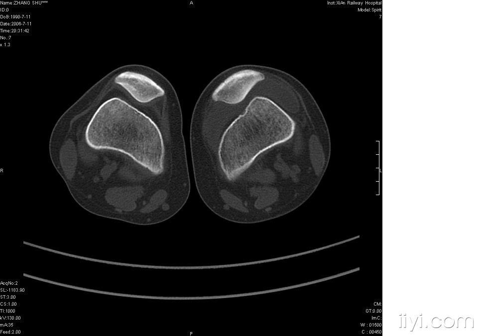 膝关节病变疑难病例恳请各位老师高手指点