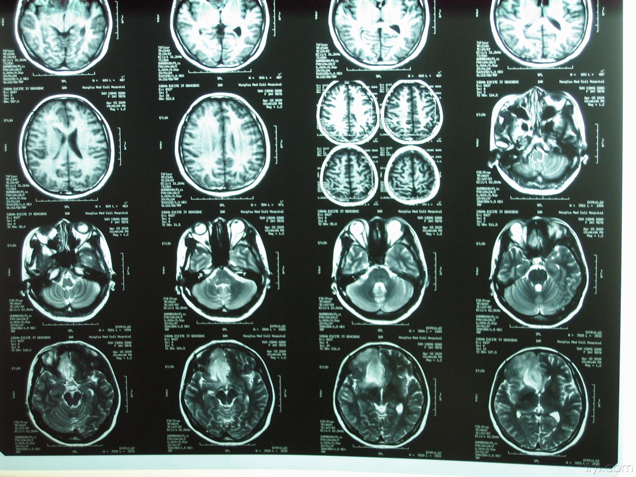 脑外伤后行头ct无意中发现脑肿瘤