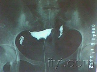 这是今天做的一个子宫输卵管造影,请大家欣赏