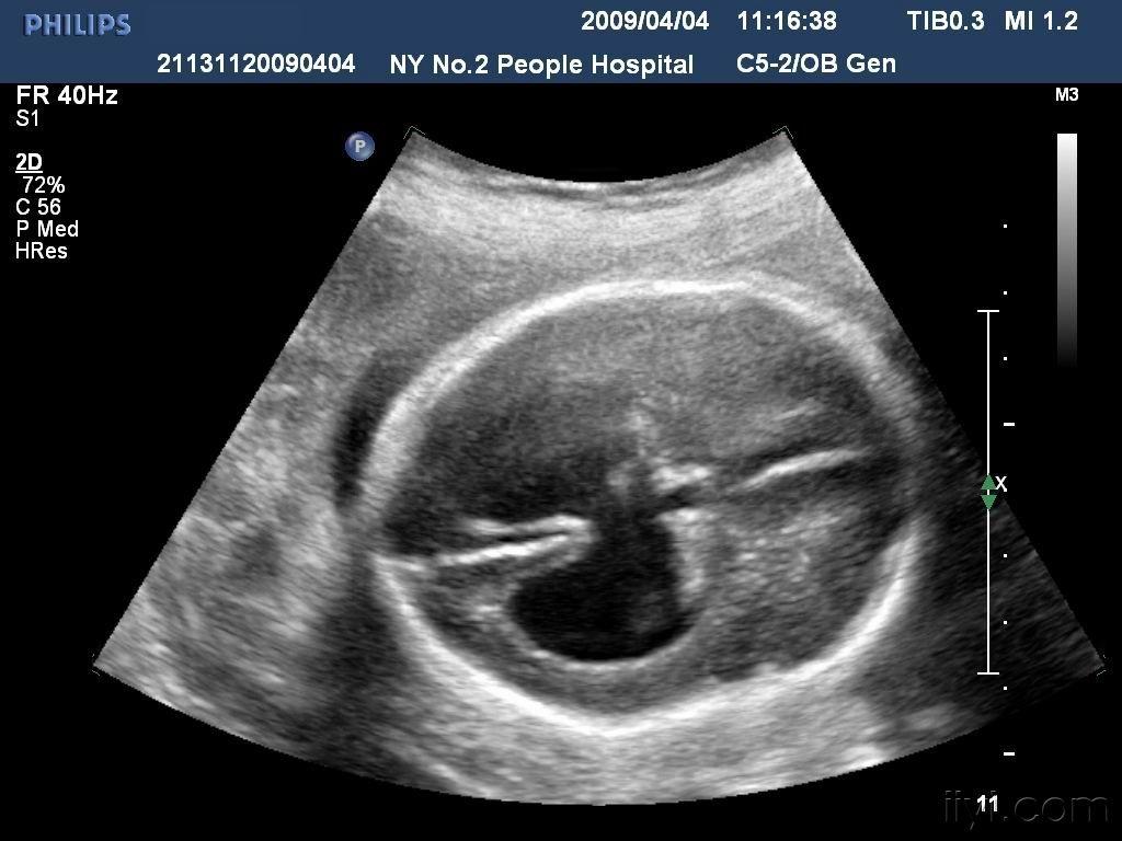 胎儿多发畸形 - 超声医学讨论版 - 爱爱医医学论坛