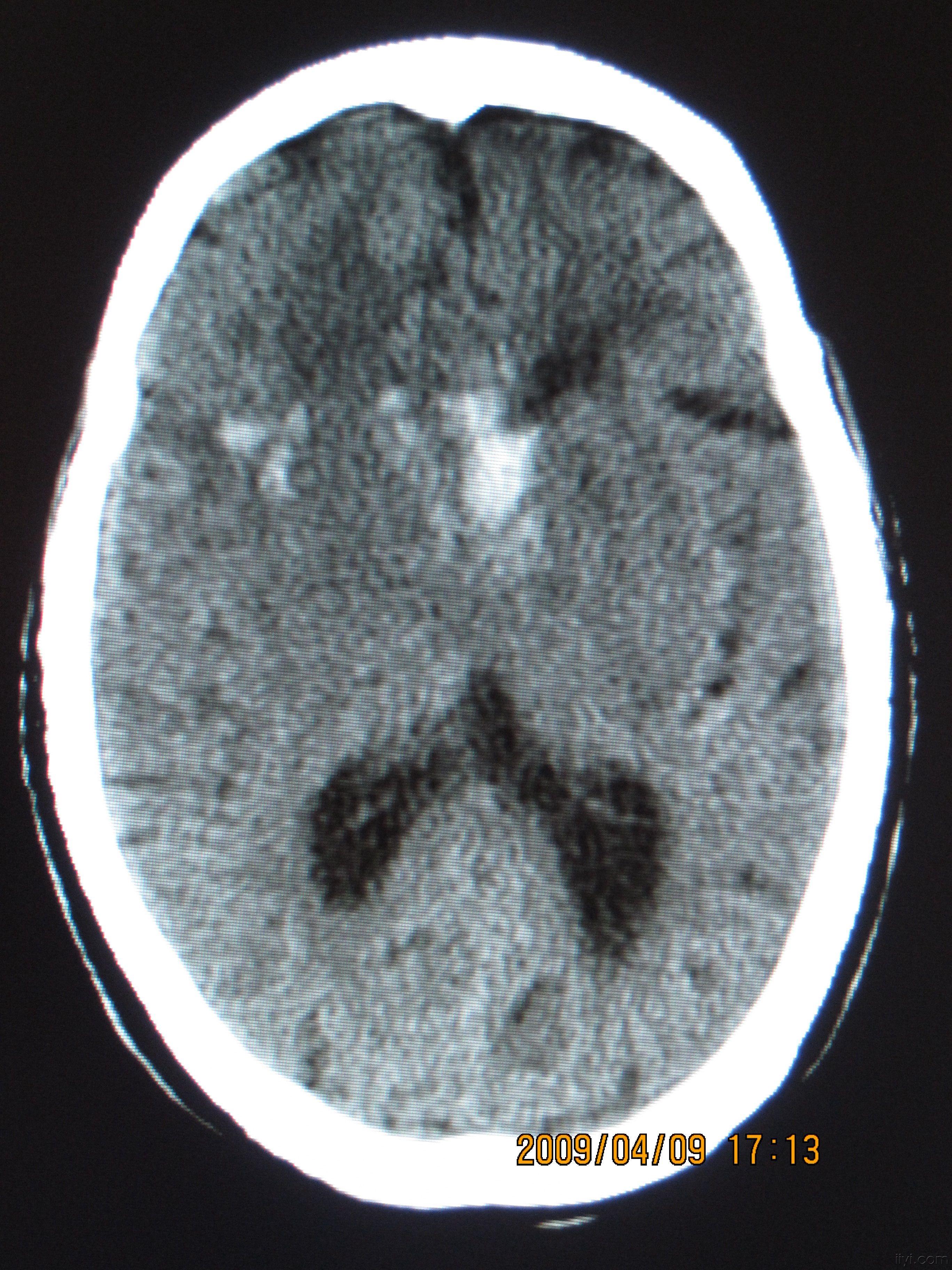 头颅ct平扫图象